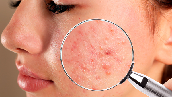 Microbotox: Avaliação prospectiva da melhora dermatológica em pacientes com acne leve a moderada e rosácea eritematotelangiectásica