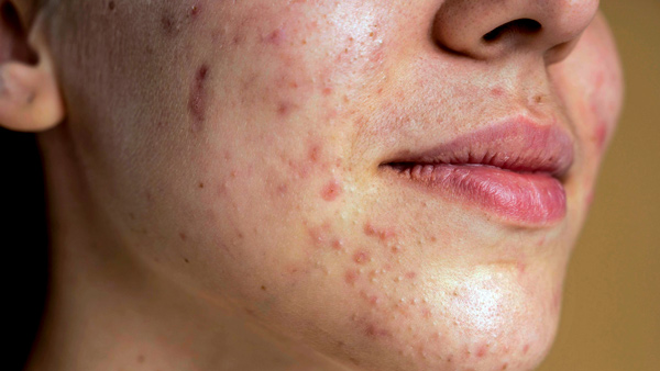 Tratamento adjuvante para acne vulgar com ácido tranexâmico